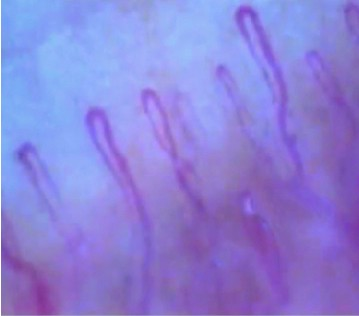 Microvascular blood circulation before skin contact with Far Infrared Flooring